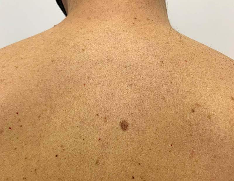 Dysplastic naevus on a man's back