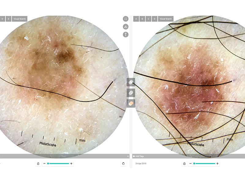 Changes on dermoscopic photography, leading to a diagnosis of melanoma