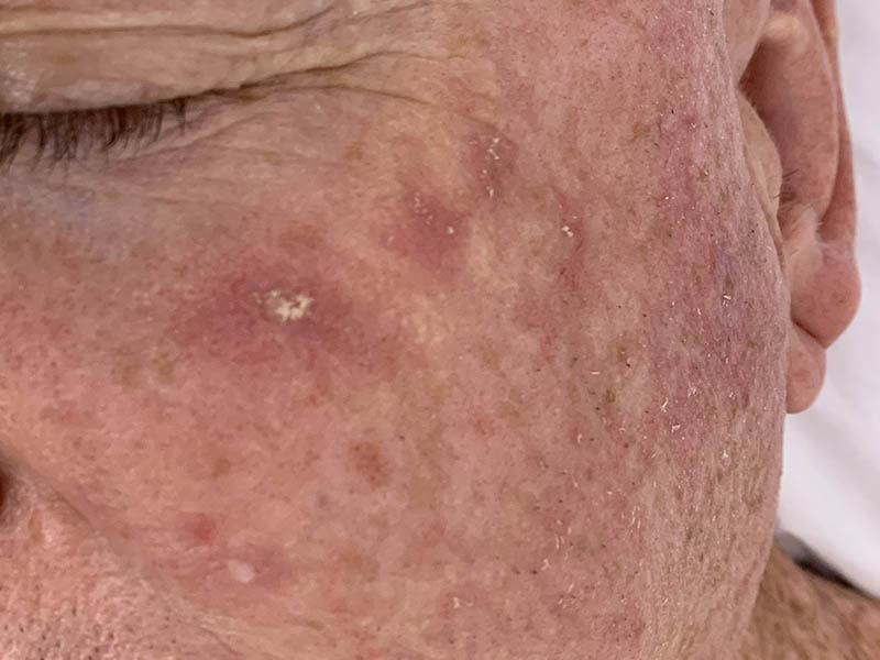 Multiple solar keratoses on a man's cheek