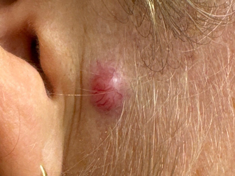 Nodular melanoma