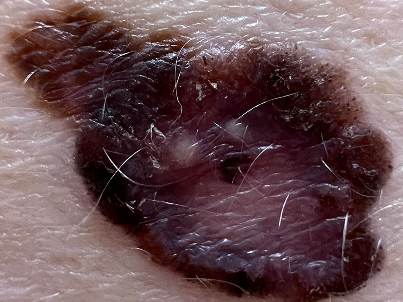 Macro view of an invasive melanoma