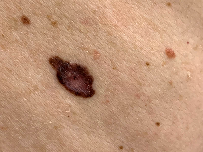 Invasive melanoma on a man's back