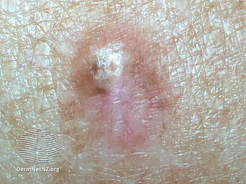 Amelanotic melanoma