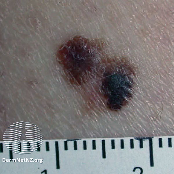 Superficial spreading melanoma