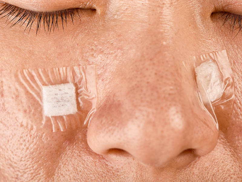 Dressings after facial mole removal