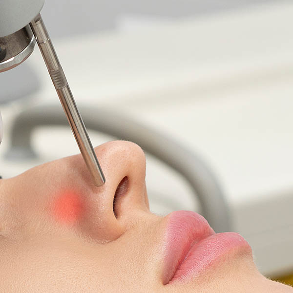 http://Vascular%20laser%20treatment%20to%20vessels%20on%20nose,%20close-up