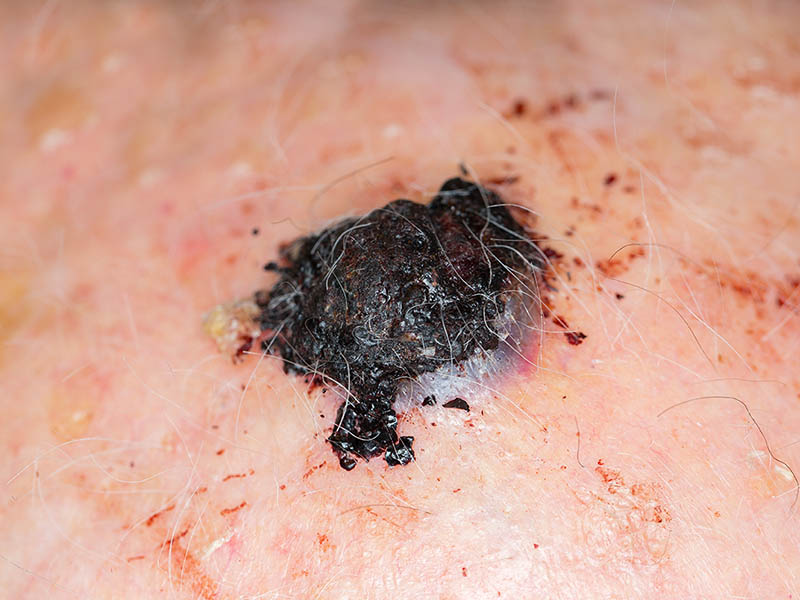 Close-up view of melanoma