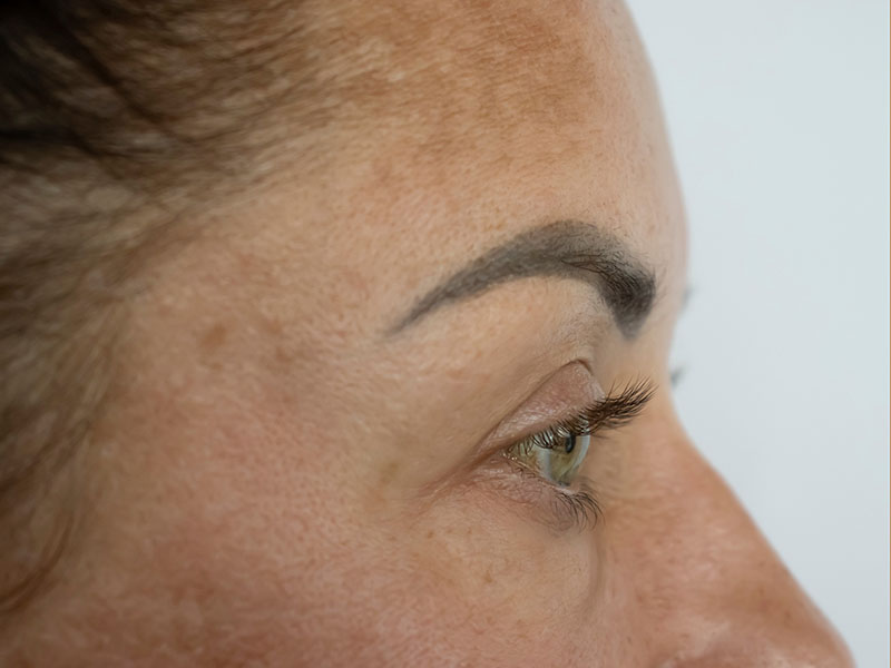 Melasma, seen from right profile