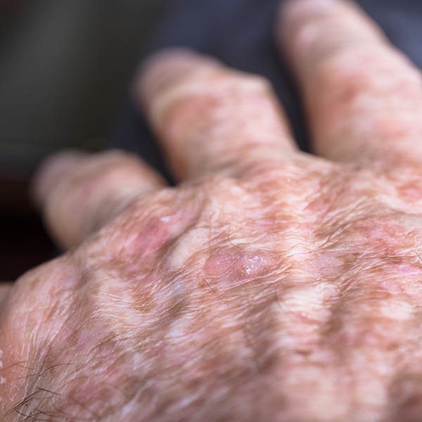 Solar keratoses on the back of a hand