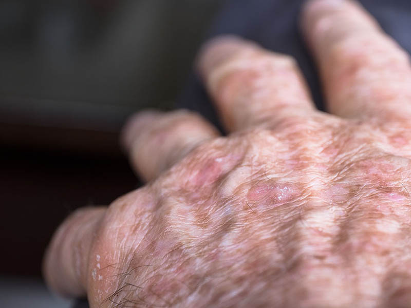 Solar keratoses on the back of a hand