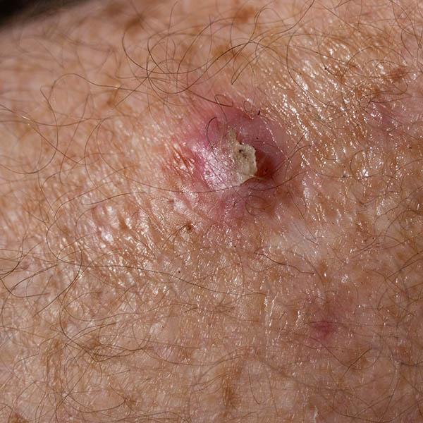 Squamous cell carcinoma