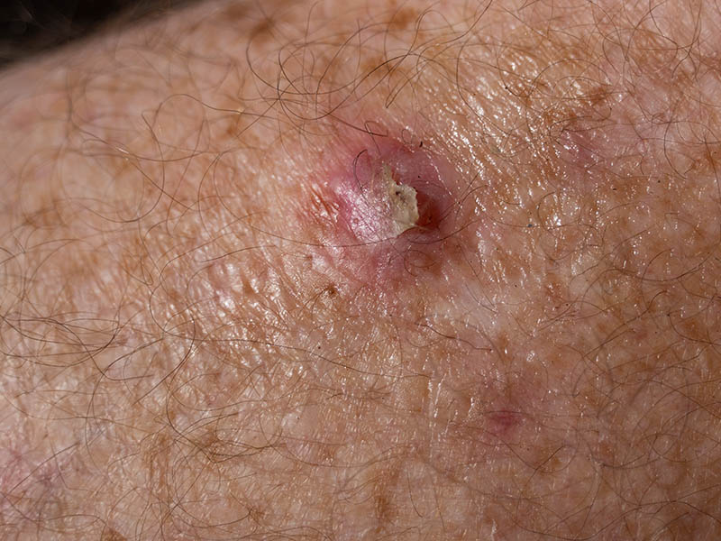 Squamous cell carcinoma