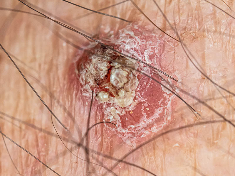 Close-up view of squamous cell carcinoma