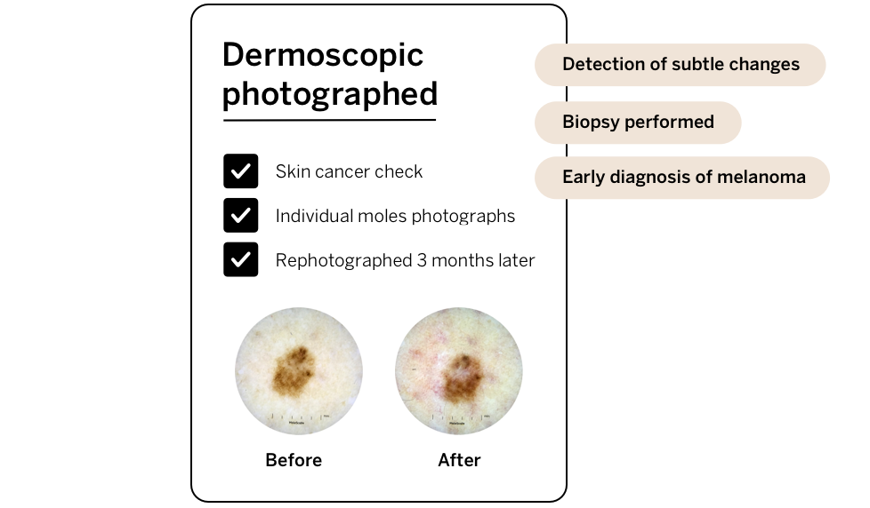 Serial dermoscopic photography can help early diagnosis of skin cancers