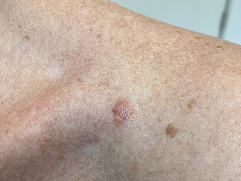 Lichenoid keratosis on a man's shoulder