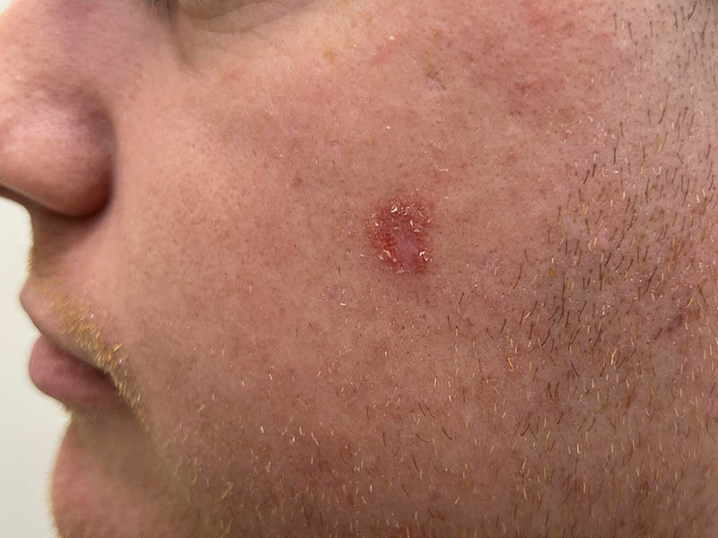 Lichenoid keratosis on a man's cheek