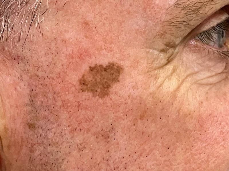 large dark lentigo on a man's cheek