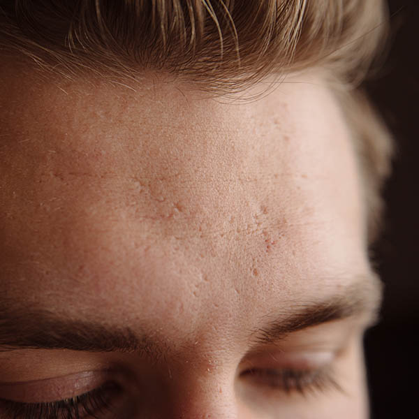 http://Acne%20scars%20on%20a%20man's%20forehead