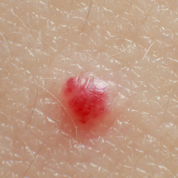 Angioma