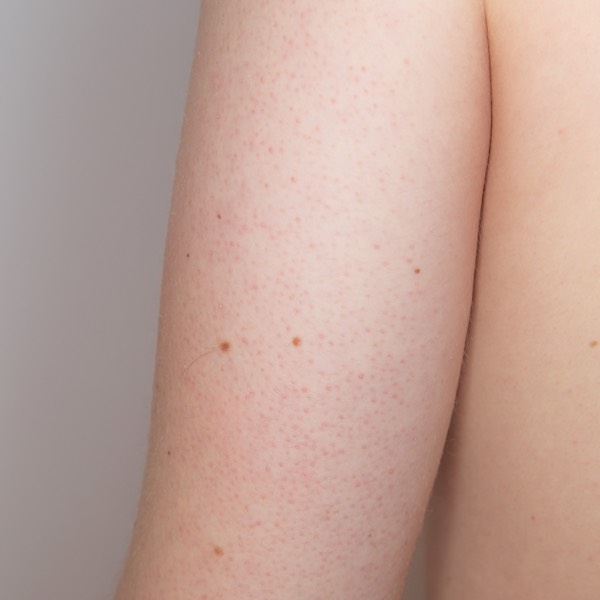 Keratosis pillaris affecting the upper arm