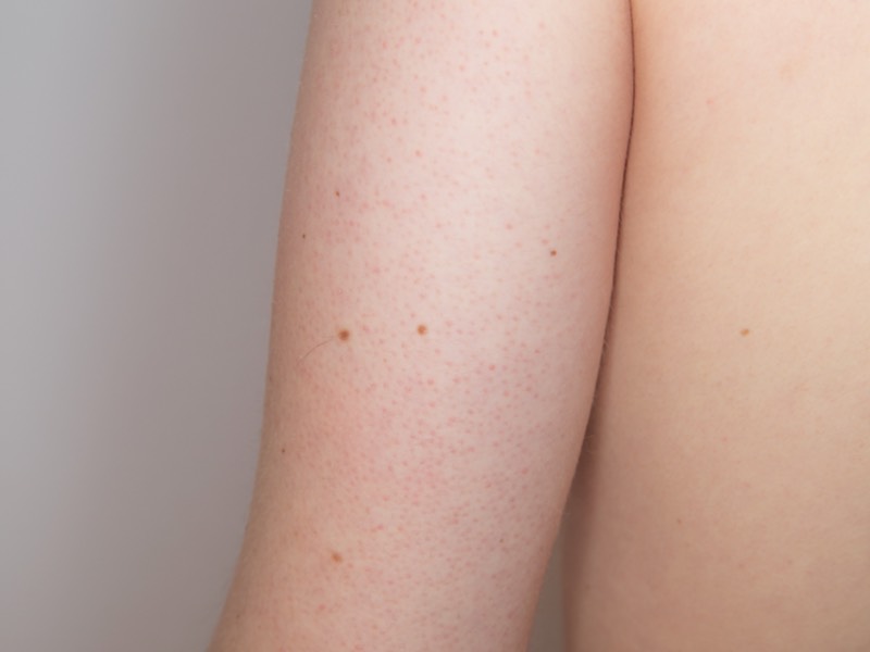 Keratosis pilaris