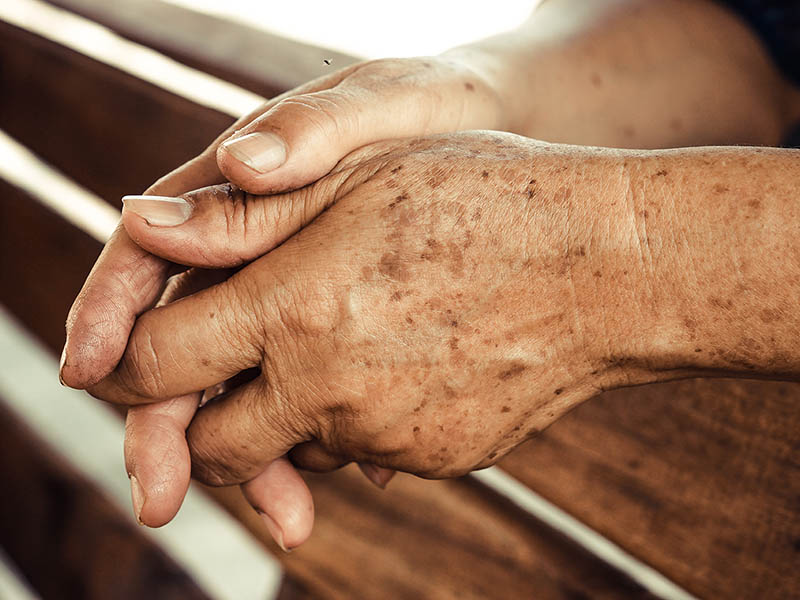 Lentigines on a woman's hands