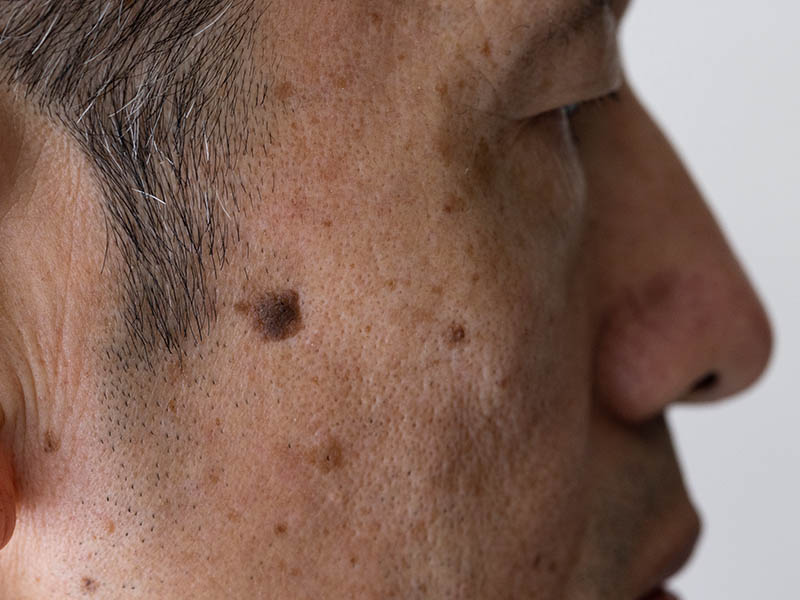 Profile view of a man with a seborrhoeic keratosis on his right temple