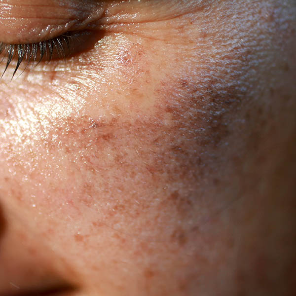 Close-up view of melasma on a woman's left cheek