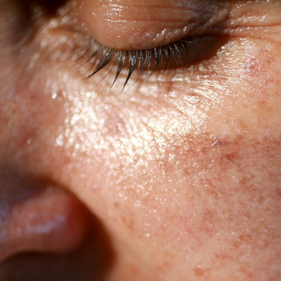 Melasma affecting a woman's left cheek