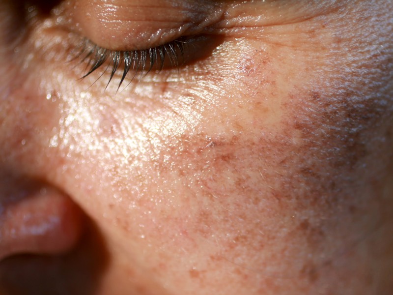 Melasma affecting a woman's left cheek