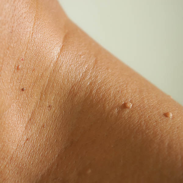 Multiple skin tags on a woman's shoulder