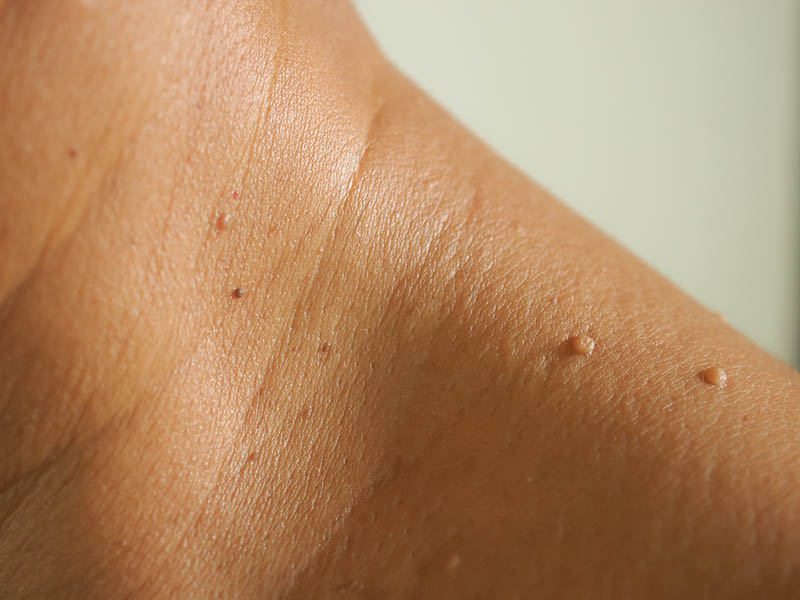 Multiple skin tags on a woman's shoulder