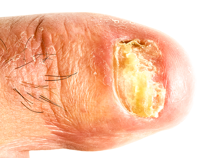 Thickened and crusted nail in onychomycosis