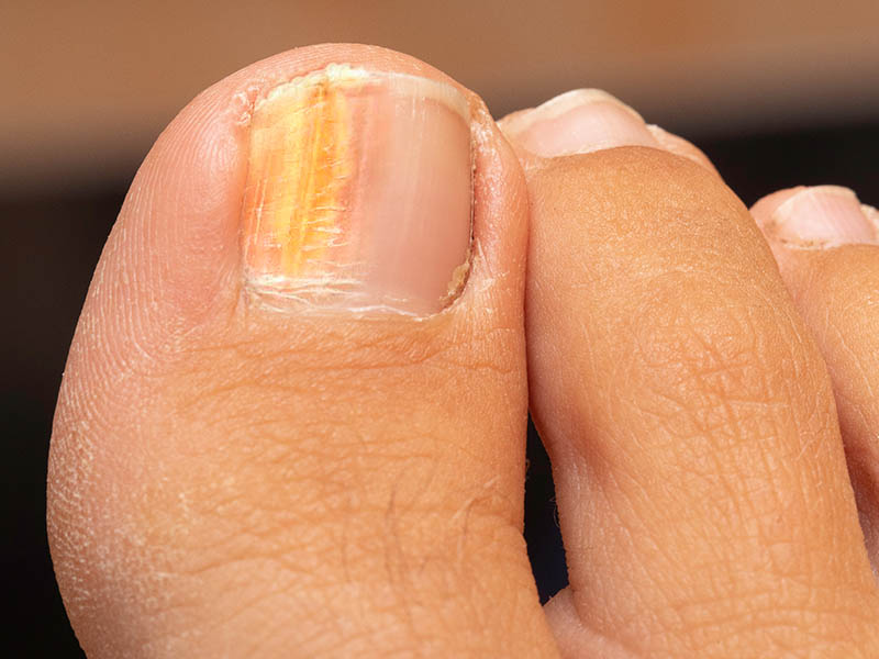 Discoloured nail in onychomycosis