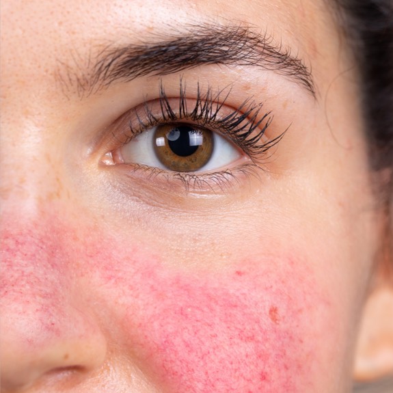 Rosacea of the cheeks and nose