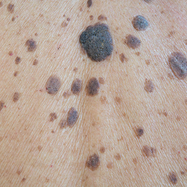 Multiple seborrhoeic keratoses