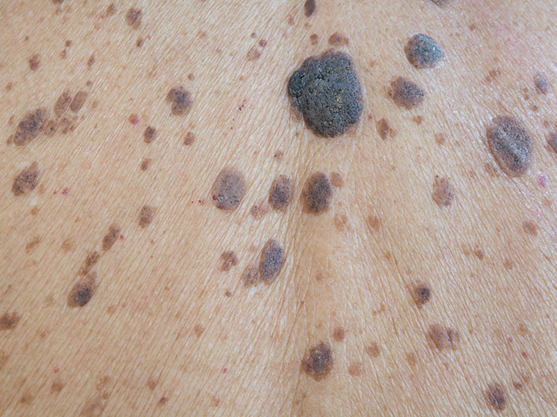 Multiple seborrhoeic keratoses