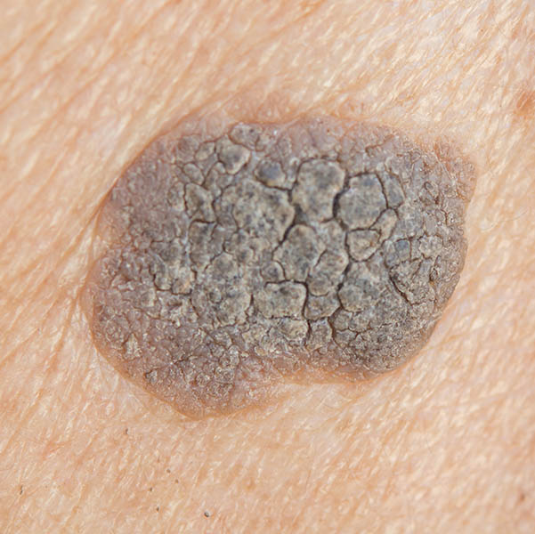 Seborrhoeic keratosis - close-up view