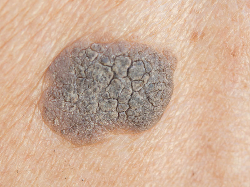 Seborrhoeic keratosis - close-up view