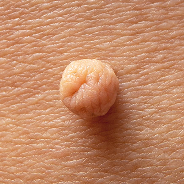 Close-up view of a skin tag