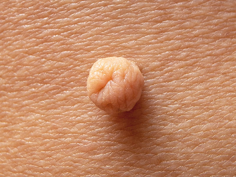 Close-up view of a skin tag