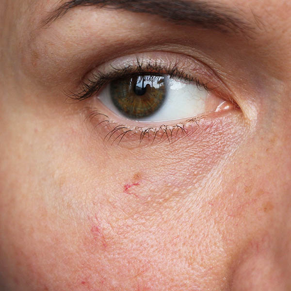 Telangiectasia on a woman's cheek