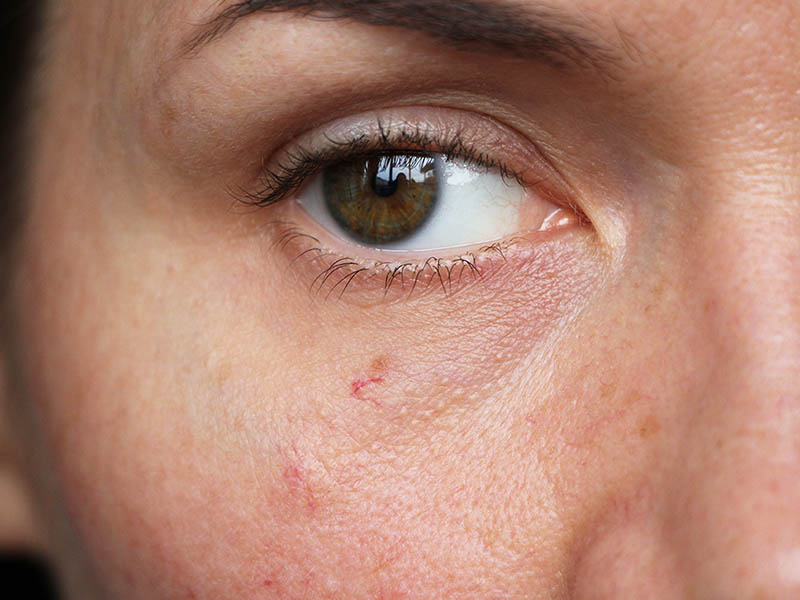 Telangiectasia on a woman's cheek