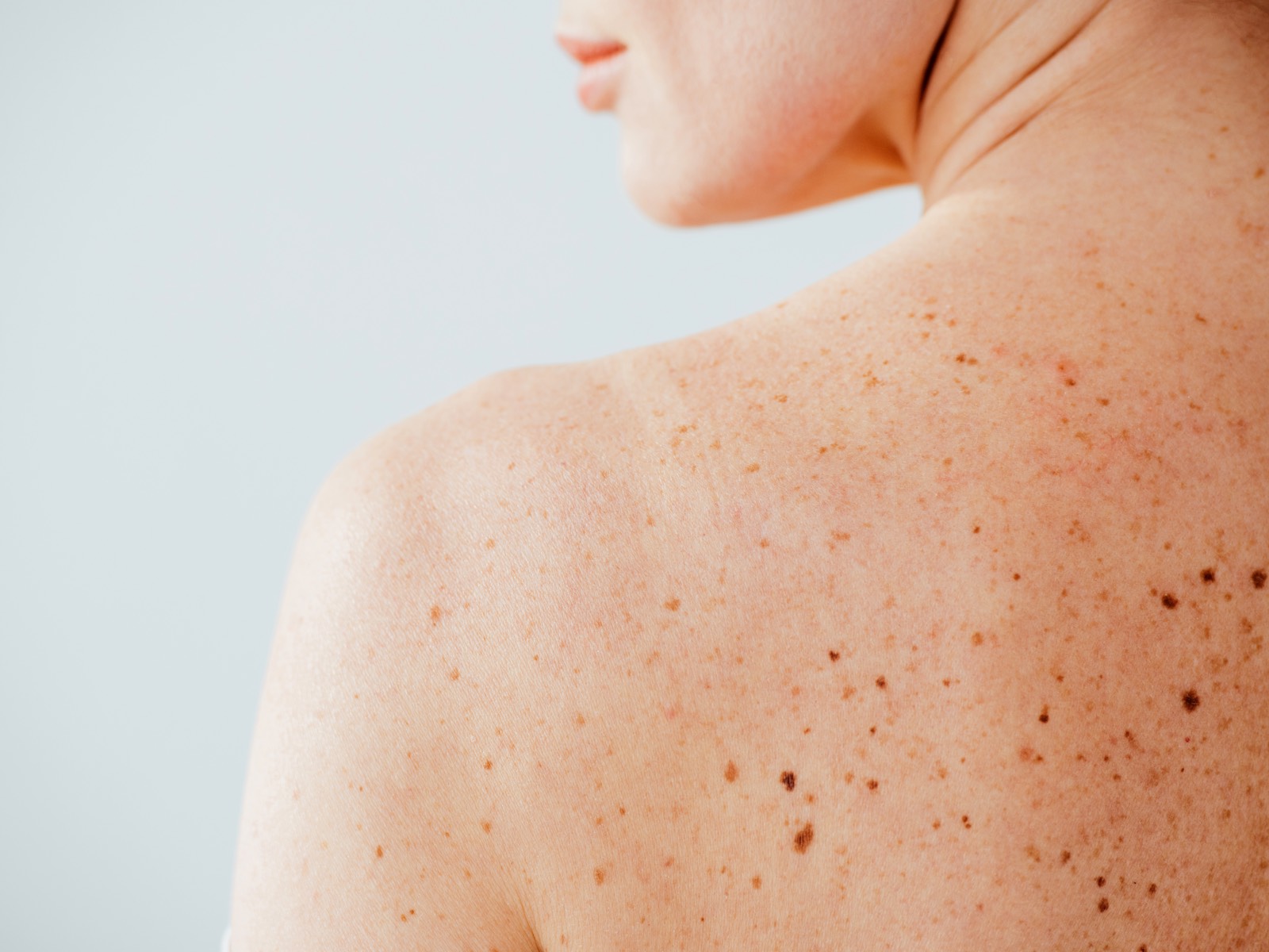 A woman's upper back, showing multiple moles