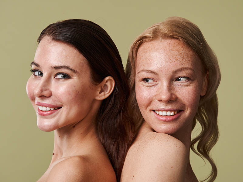 Two young women, one with acne scarring, another with fair skin and freckles