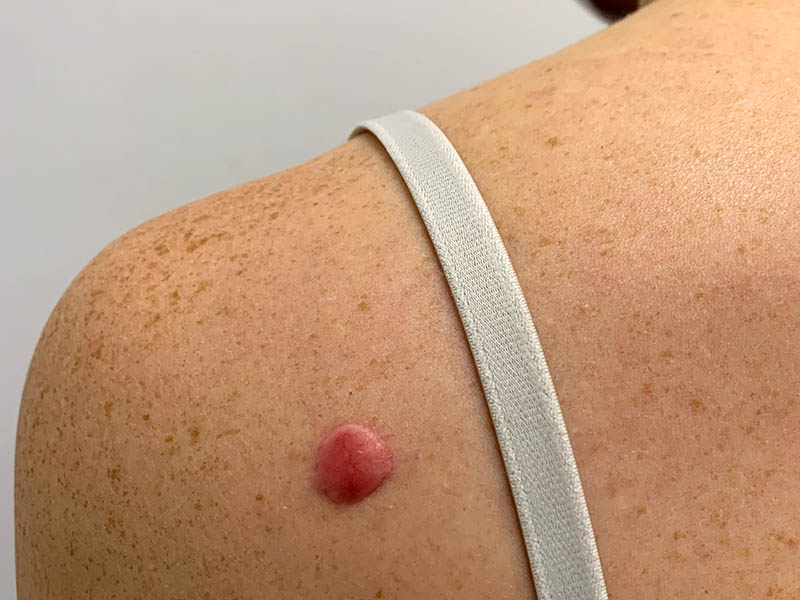 Keloid scar following mole removal procedure left shoulderblade