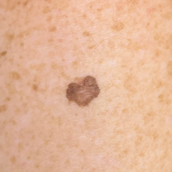 Spot Check | Melanoma in situ