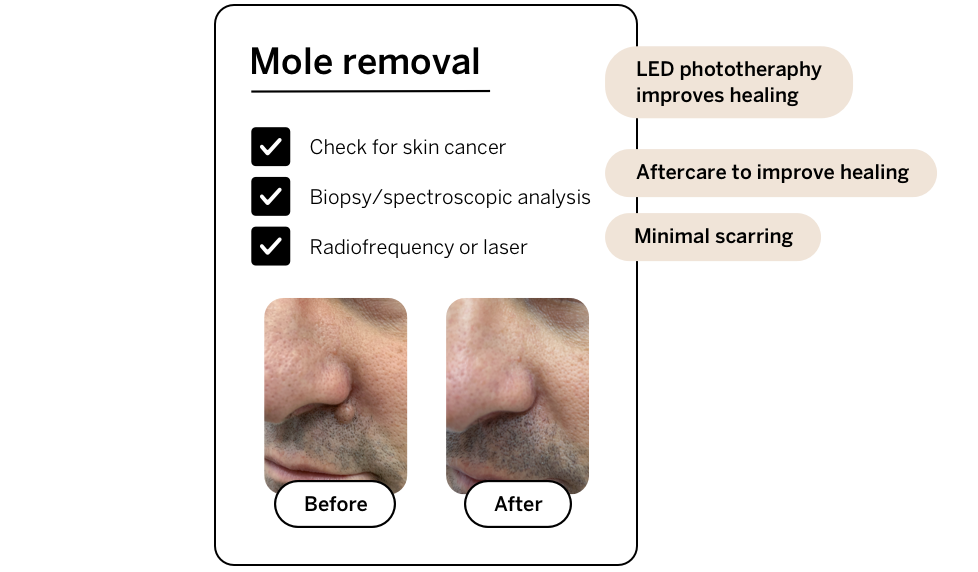 Before and after cosmetic mole removal