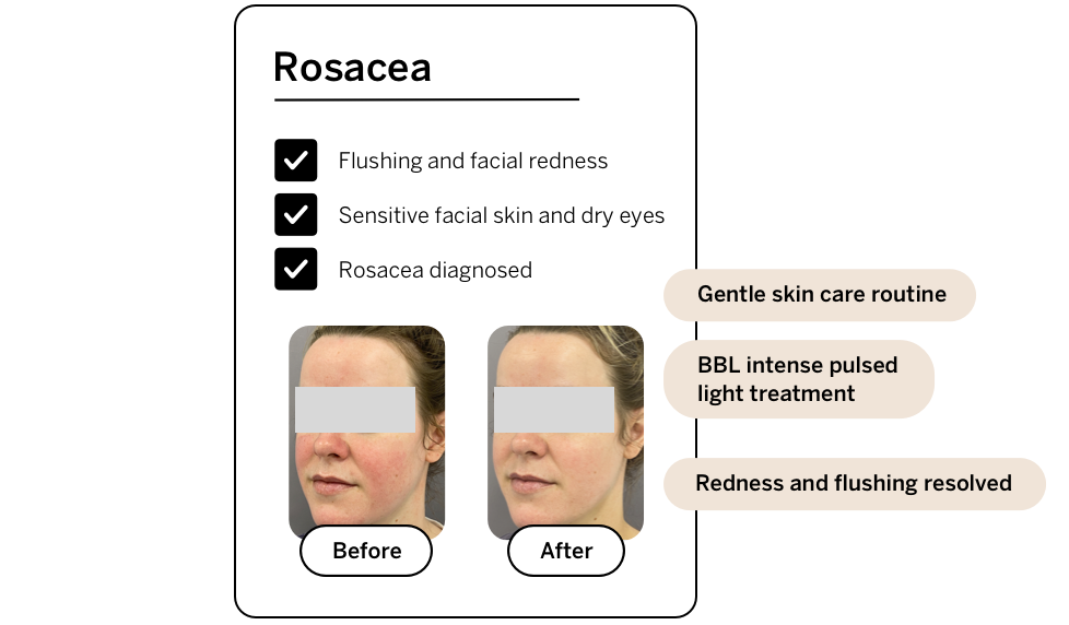 Before and after rosacea treatment - call to action