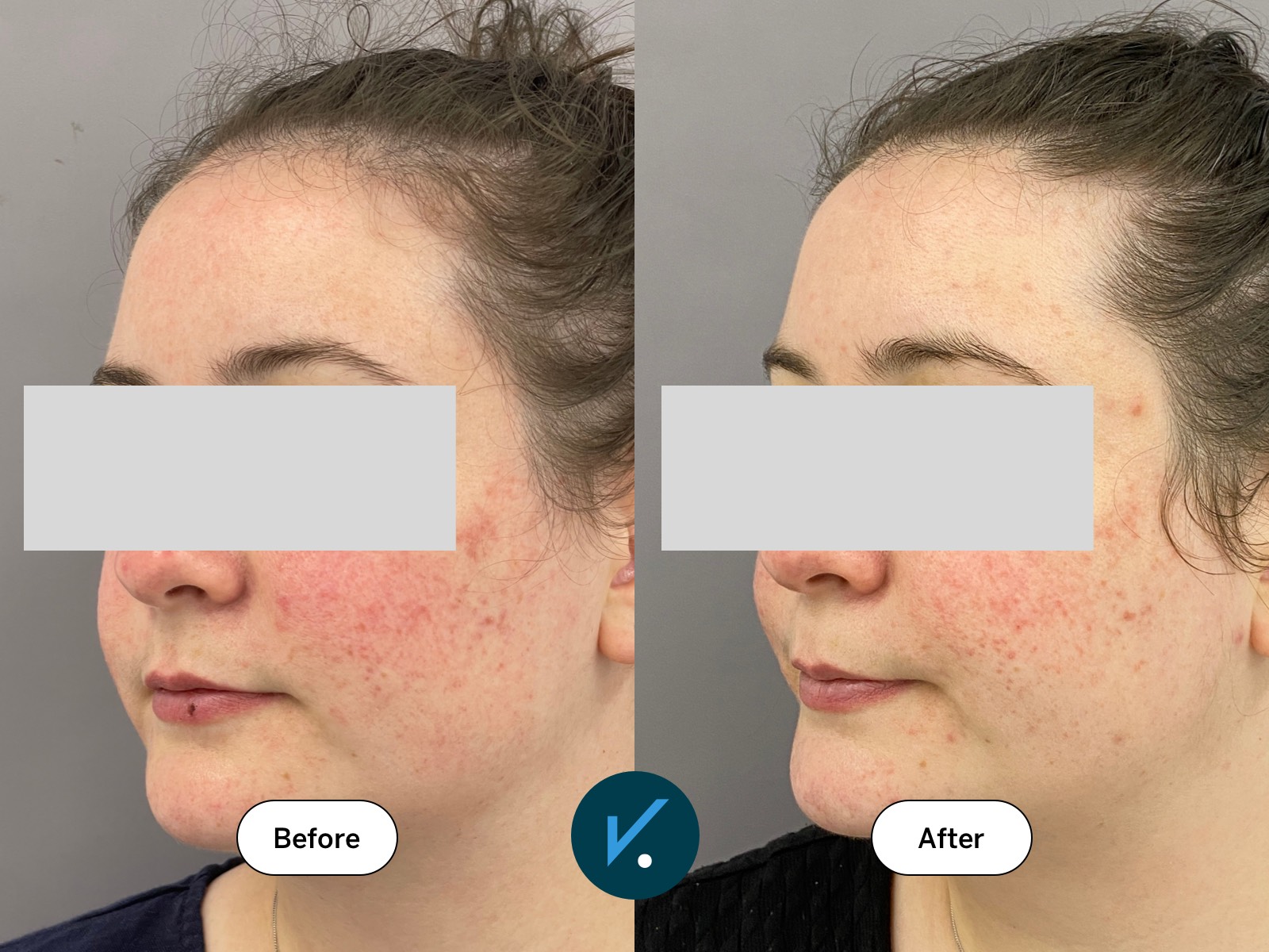 Before and after a single BBL treatment for rosacea